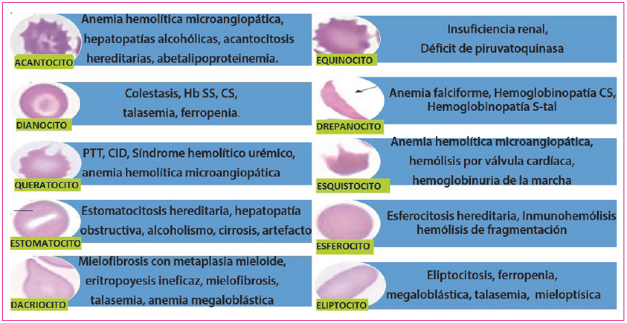 Figura 5. Morfologías del hematíe y patologías en las que es más frecuente su aparición