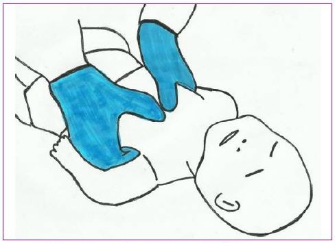 Figura 4. Masaje cardiaco en el recién nacido y el lactante