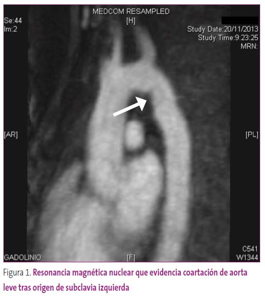 Figura 1. Resonancia magnética nuclear que evidencia coartación de aorta leve tras origen de subclavia izquierda