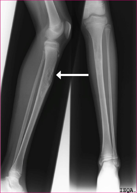 Figura 1. Radiografía. Lesión ósea bien delimitada en diáfisis proximal de la tibia, margen escleroso sin rotura de cortical