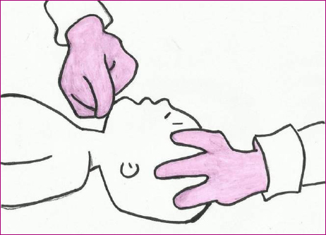 Figura 1. Maniobra frente-mentón en el recién nacido y el lactante sin hipextensión del cuello