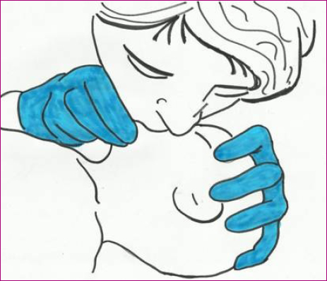Figura 2. Maniobra de insuflación boca-nariz en el recién nacido y el lactante