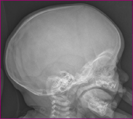 Figura 1. Radiografía lateral de cráneo del paciente