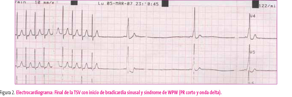 Figura 2. Electrocardiograma: Final de la TSV con inicio de bradicardia sinusal y síndrome de WPW (PR corto y onda delta)