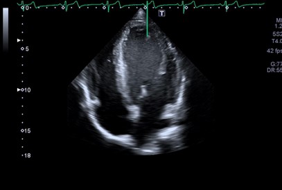 Ecocardiografía con dilatación en ventrículo y aurícula izquierdas de un deportista de baloncesto de 14 años