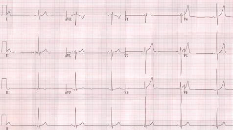 Bradicardia sinusal, estimada una frecuencia cardiaca en torno a 45 lpm