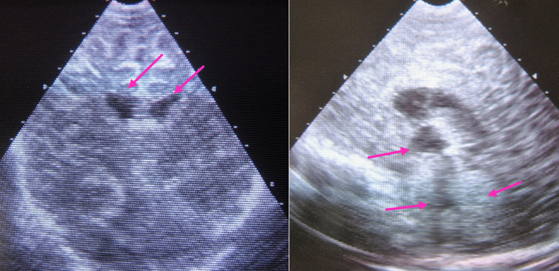 Izquierda, corte coronal; flechas: ventrículos laterales. Derecha, corte sagital. Flecha izquierda superior, III ventrículo; izquierda inferior, IV ventrículo, y derecha cerebelo.