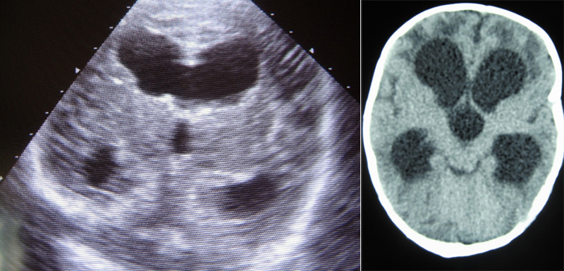 Hidrocefalia. La ecografía (izquierda), con el corte coronal, y la TC (derecha) muestran dilatación triventricular.