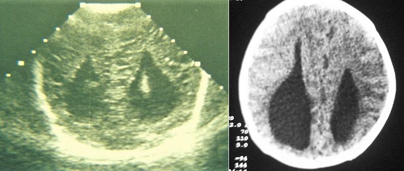 La ecografía (izquierda), con el corte coronal posterior, y la TC (derecha) muestran dilatación y verticalización de las astas posteriores de los ventrículos laterales, signo indirecto de agenesia de cuerpo calloso.