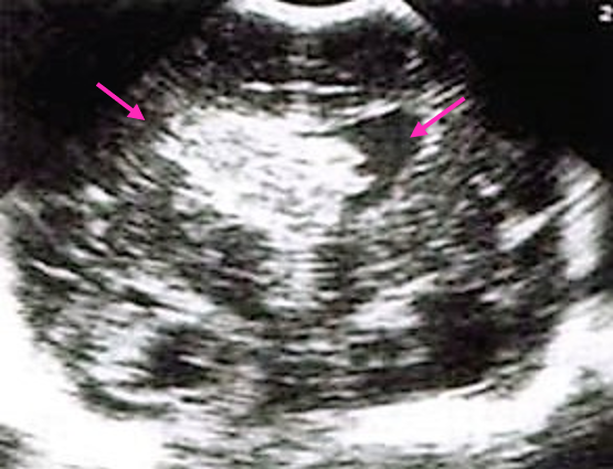 Ecografía con el corte coronal. Hemorragia intraventricular con extensión parenquimatosa (gran imagen hiperecoica, flecha izquierda) con dilatación ventricular (flecha derecha). HIV de grado IV.