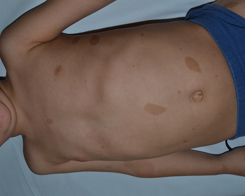 Manchas café con leche en un caso confirmado de neurofibromatosis tipo 1