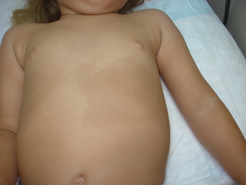 Mosaicismo hiperpigmentado