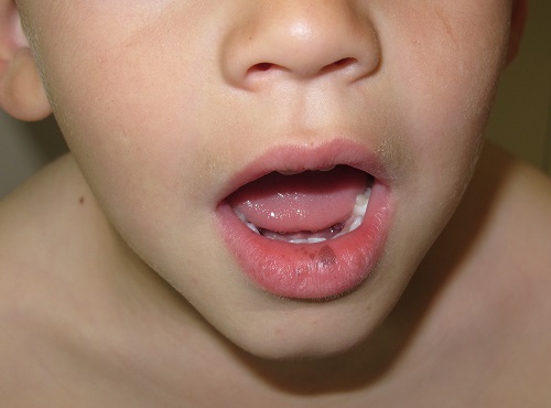 Síndrome de Peutz-Jeghers.