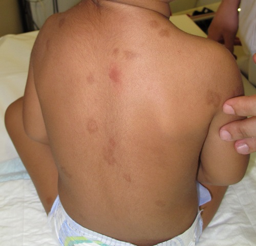 Mastocitosis. Lesiones hiperpigmentadas que se enrojecen tras el roce (signo de Darier).