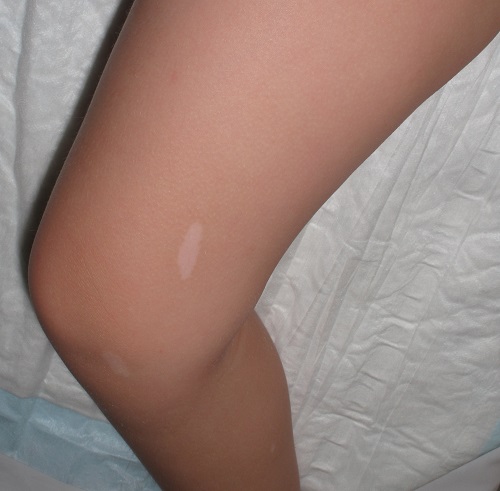 Máculas en hoja de fresno en la esclerosis tuberosa.