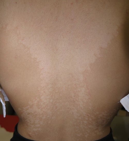 Pitiriasis versicolor.