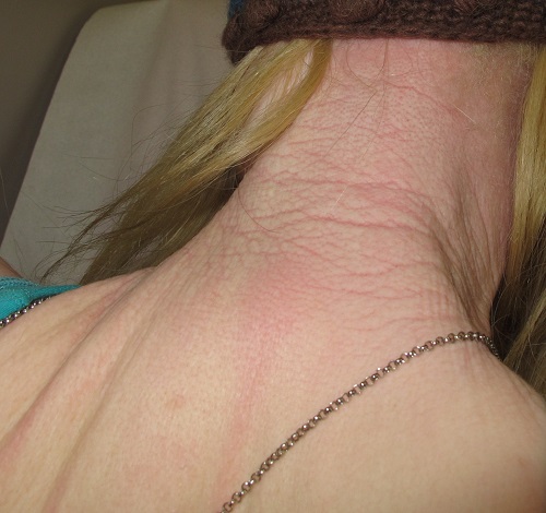 Daño solar en albinismo.