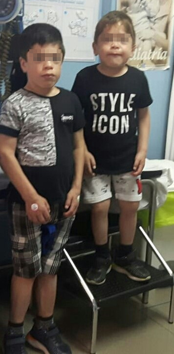 Facies y fenotipo de los pacientes de 10 y 12 años con síndrome de Hunter moderado