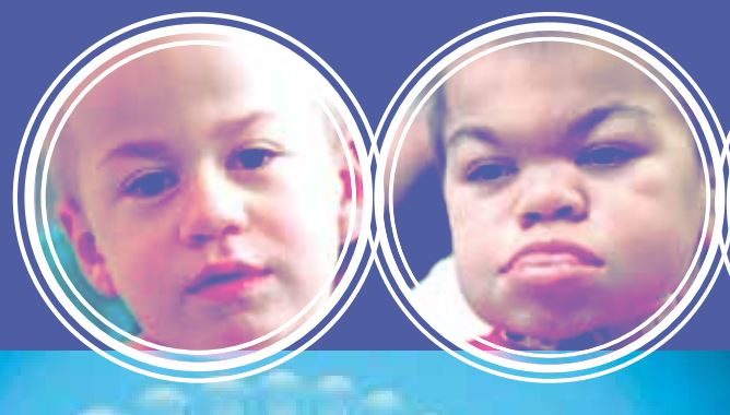 Facies de síndrome de Hunter leve y grave