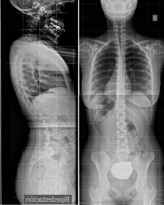 Columna vertebral vista desde atrás: la punta del corazón y la cámara del fundus gástrico los veremos a la izquierda.