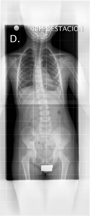 Posición inadecuada, actitud escoliótica.