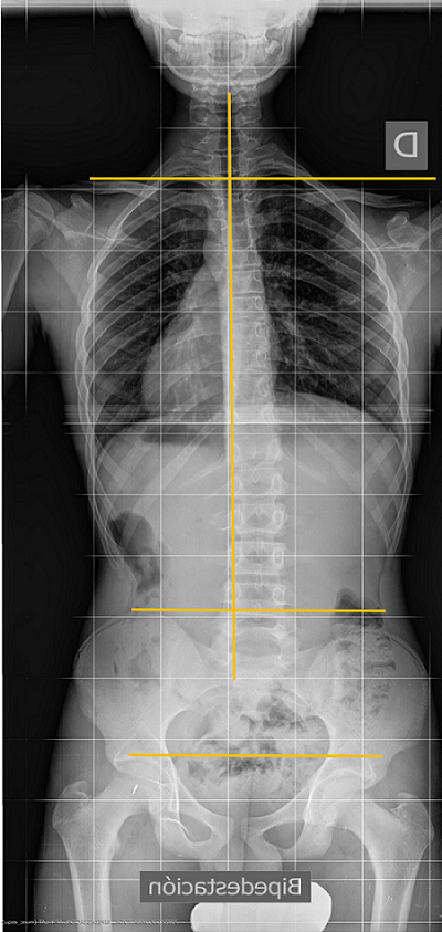 Escoliosis posicional. Dismetría de miembros inferiores: la columna vertebral se inclina hacia el lado más alto y además eleva el hombro del mismo lado. Es una situación mecánicamente ilógica, debida a posiciones que adoptan los pacientes en el momento de hacer la radiografía. 