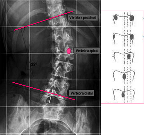 Angulo de Cobb e índice de Moe de la escoliosis. El ángulo de Cobb se determina entre las dos vértebras que están más inclinadas hacia la concavidad, límites a su vez de la curva escoliótica. El índice de Moe valora la imagen asimétrica de los pedículos y da información de la importancia de la rotación de la vértebra ápex.