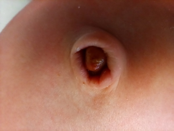 Granuloma umbilical