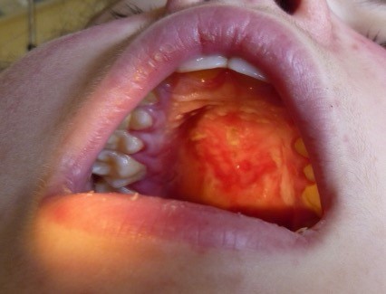 Figura 1. Lesiones erosivas superficiales que afectan sobre todo a paladar blando y duro.