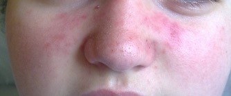 Figura 2. Lesión eritematosa en alas de mariposa que afecta parte superior de ambas mejillas y puente de la nariz.