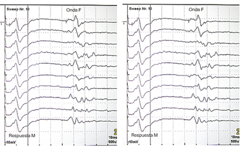 Figura 3. Potencial de acción motor (izquierda), onda F (derecha