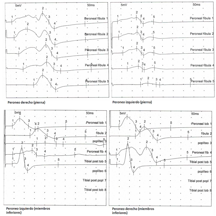 Figura 1. Resultados del estudio de conducción motora del nervio peroneo derecho e izquierdo de nuestro paciente. 