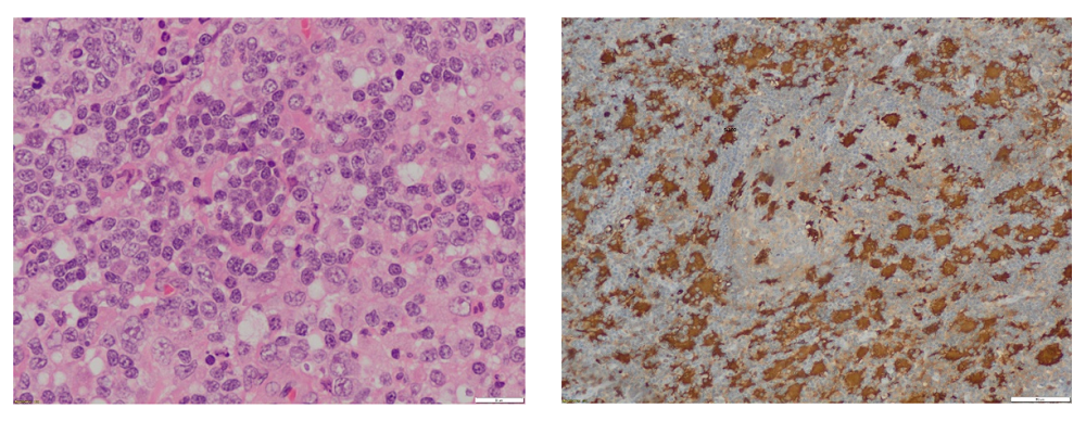 Imagen histológica de enfermedad Rosai Dorfman