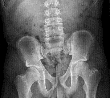 Figura 1. Radiografía anteroposterior de pelvis: ensanchamiento de la cabeza femoral bilateral y dismetría de miembros inferiores (derecho acortado).