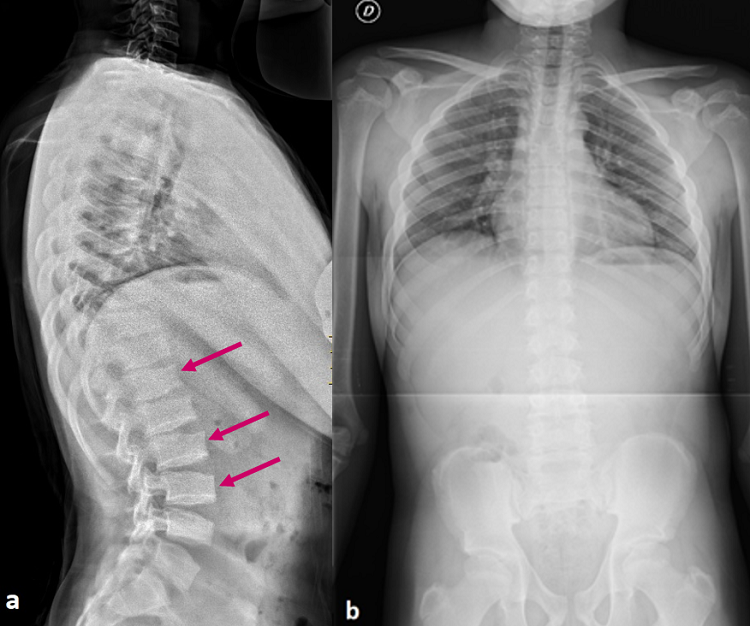 a) Radiografía lateral de columna vertebral: se observa platispondilia (cuerpos vertebrales planos) con 'jorobas' en los platillos inferiores y superiores de los cuerpos vertebrales (flechas) e hiperlordosis lumbar. b) Radiografía anteroposterior de columna vertebral: escoliosis leve y asimetría de hombros compensatoria.