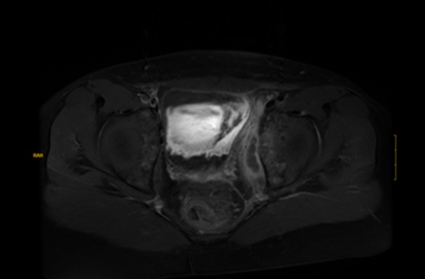 Figura 1. Imagen de resonancia magnética nuclear en secuencia T2 con contraste de gadolinio donde se observa colección intramuscular hipointensa a nivel del músculo obturador interno sugestiva de absceso intramuscular.