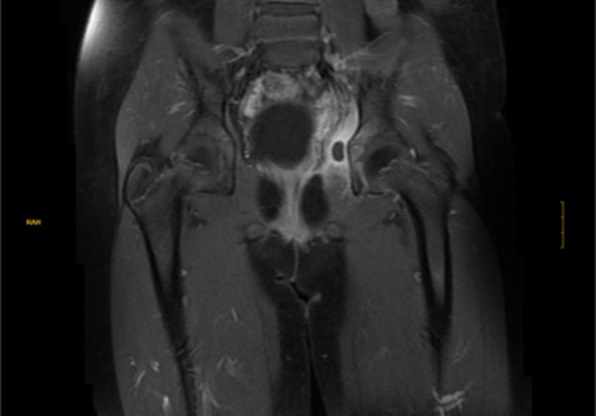 Figura 2. Imagen de resonancia magnética nuclear en secuencia T1 donde se observa hiperrealce a nivel de tercio proximal del obturador interno sugestiva de piomiositis.