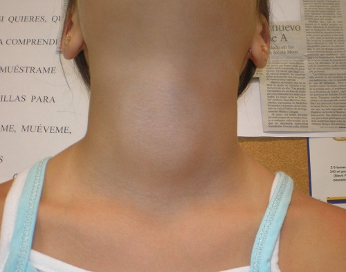 Figura 2. La misma paciente con el cuello en extensión.