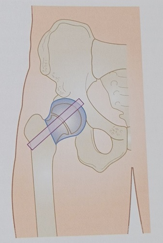 Figura 1. El transductor se sitúa en un plano sagital paralelo al cuello femoral.
