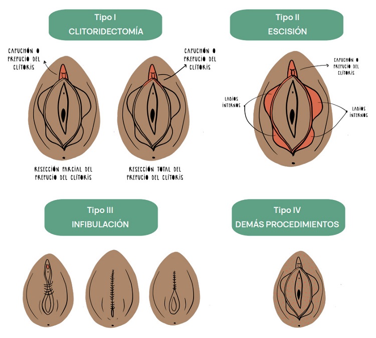 Figura 1. Tipos de mutilación genital femenina.