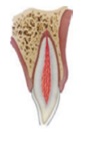 Figura 2. Fractura coronal (esmalte).