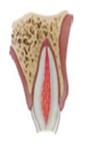 Figura 3. Fractura coronal no complicada.