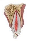 Figura 4. Fractura corono-radicular no complicada.