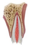 Figura 5. Fractura coronal.