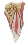 Figura 6. Fractura corono-radicular no complicada.