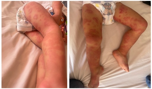 Figura 1. Paciente con urticaria multiforme. Se pueden observar las placas eritematosas policíclicas, algunas de ellas con coloración violácea central, junto con un discreto edema acral.