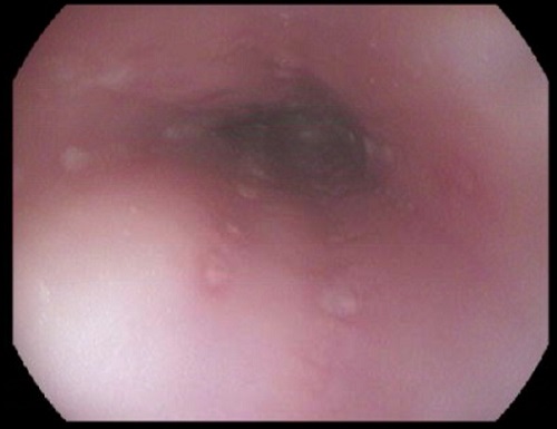 Figuras 1 y 2. Endoscopia digestiva alta en la que se objetivan úlceras circunscritas cubiertas de fibrina, con bordes sobreelevados y surcos longitudinales en todo el trayecto esofágico, con estómago y duodeno sin alteraciones. 
