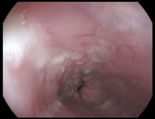 Figuras 1 y 2. Endoscopia digestiva alta en la que se objetivan úlceras circunscritas cubiertas de fibrina, con bordes sobreelevados y surcos longitudinales en todo el trayecto esofágico, con estómago y duodeno sin alteraciones. 