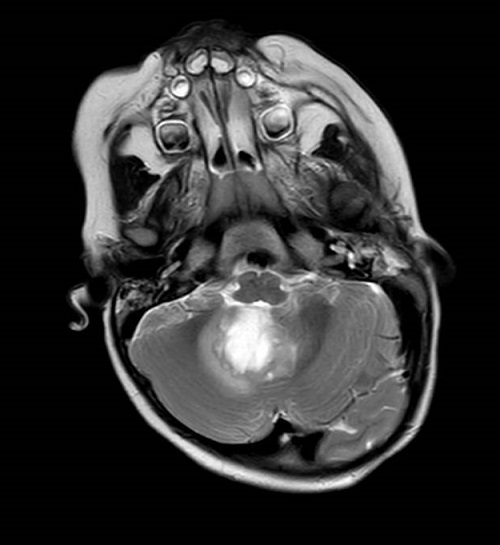 Figura 2. Imagen de resonancia magnética en corte axial donde se visualiza la lesión de fosa posterior con afectación del 4.º ventrículo, con intenso realce de contraste de 2,8 x 2,3 x 2,6 cm. Edema periférico moderado.