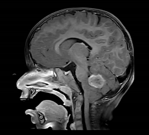 Figura 3. Imagen de resonancia magnética en corte transversal donde se visualiza una lesión tumoral infratentorial hemisférica paracentral derecha; comprime la base del 4.º ventrículo sin obstrucción y no produce hidrocefalia obstructiva de 3.º ventrículo ni laterales.
